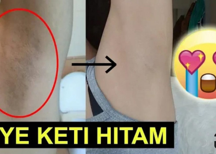 3 Cara Gampang Memutihkan Ketiak Hitam dengan Bahan Alami Dalam Semalam, Ampuh Hilangkan Bau Badan Permanen