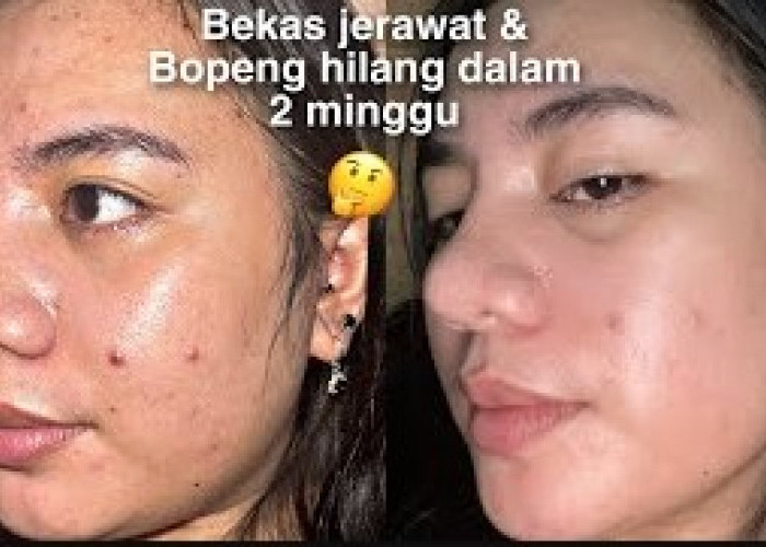 4 Skincare Penghilang Bopeng dan Noda Hitam, Bikin Wajah Glowing Mulus dengan Cepat