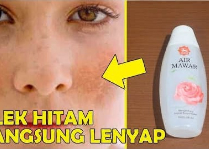 Inilah 3 Cara Menghilangkan Flek Hitam dengan Air Mawar di Malam Hari, Efektif Bikin Wajah Glowing Bebas Noda