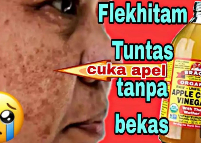 DIY Toner Cuka Apel Pengelupas Flek Hitam Menahun, Begini 2 Cara Buatnya