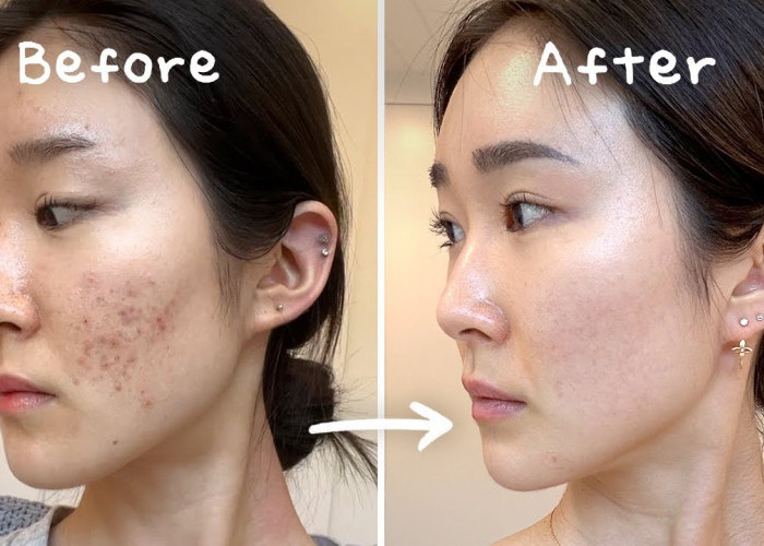 Skincare untuk Flek Hitam Terbaru 2025! Beneran Ampuh Bikin Wajah Glowing dan Mulus