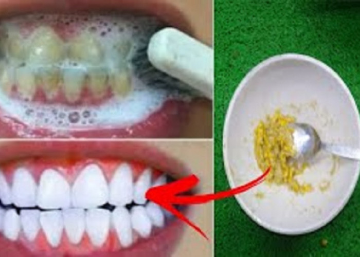 Cara Sederhana Memutihkan Gigi Kuning yang Membandel dengan Bahan Alami, Ini Dia 3 Penyebab Gigi Rusak Bernoda