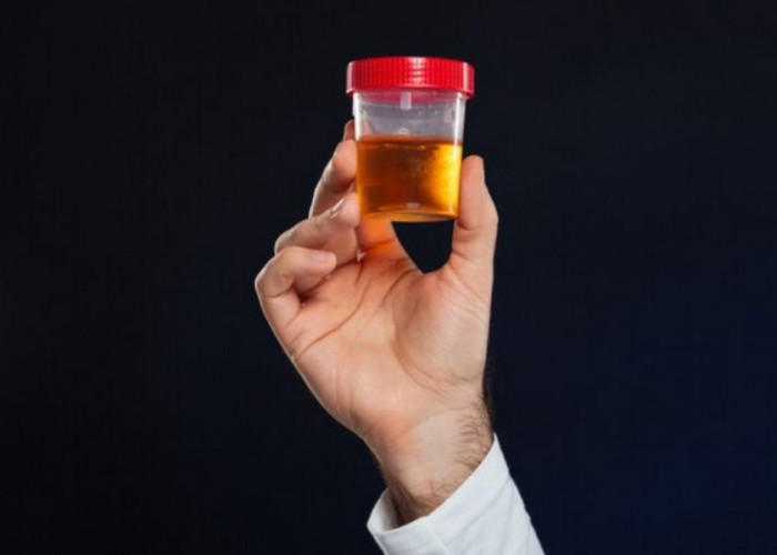 Inilah 5 Warna Urine Tidak Sehat yang Menandakan Ginjal Sedang Tidak Baik-baik Saja