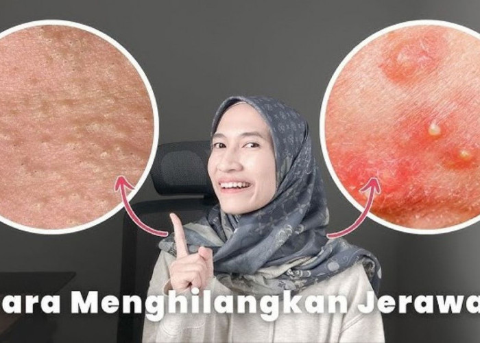 8 Cara Simpel Merawat Kulit Agar Tidak Mudah Jerawatan, Nggak Asal Pakai Skincare