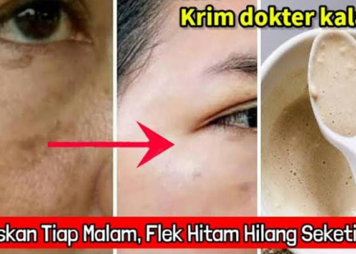 4 Cara Cepat Menghilangkan Flek Hitam yang Tebal Pakai Bahan Alami, Efektif Memutihkan Bikin Awet Muda