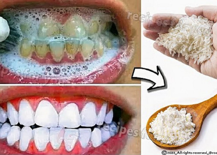 4 Cara Alami Yang Ampuh Untuk Membersihkan Karang Gigi Yang Membandel, Efektif Gigi Bersih Tanpa Plak Lagi