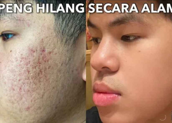 3 Skincare Pria untuk Menghilangkan Jerawat dan Bekasnya, Rahasia Wajah Mulus Permanen Gak Pake Ribet 