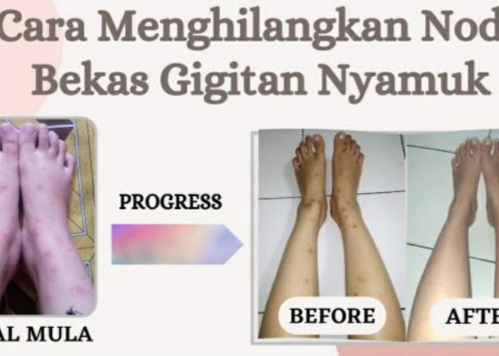 4 Cara Menghilangkan Bekas Gigitan Nyamuk Menghitam di Kaki Seperti Koreng, Kulit jadi Putih Tanpa Noda