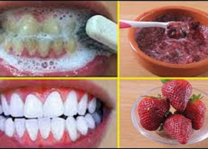 Beginilah Cara Cepat Menghilangkan Karang Gigi yang Sudah Mengeras dalam 1 Malam Pakai Bahan Alami Rumahan