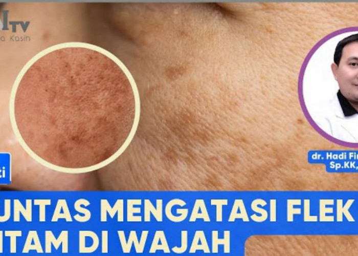 3 Rekomendasi Skincare Wardah untuk Menghilangkan Flek Hitam, Solusi Cerdas Wajah Bersih Dalam Sekali Pakai!