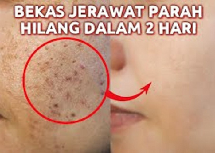 Tips Hilangkan Flek Hitam pada Ibu ibu Bonus Glowing dan Putih, Usia 40 an Wajib Tahu Cara Ini