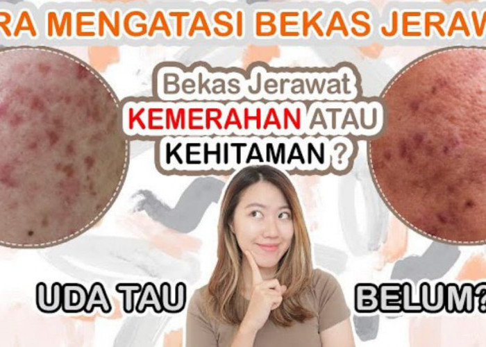 5 Masker untuk Menghilangkan Bekas Jerawat Hitam Membandel Secara Alami, Bikin Wajah Putih Glowing Sekali Usap