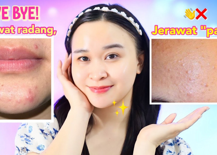 Kulit Jerawat dan Kemerahan? Ini 4 Rekomendasi Skincare untuk Memperbaiki Skin Barrier Dibawah 50 Ribuan!