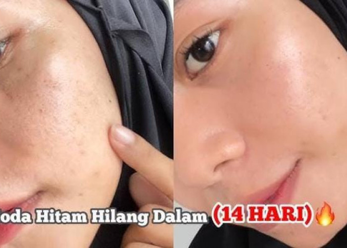 Begini Cara Pakai Toner Cuka Apel untuk Pudarkan Noda Hitam dan Cegah Kerutan, 5 Step Glowing dengan Cepat