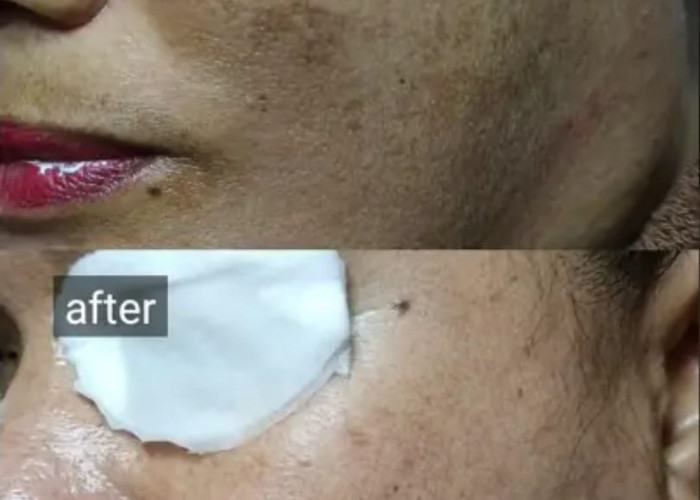 Hilangkan Flek Hitam Membandel Dalam Semalam! Ini 5 Cara Menghilangkan Melasma yang Paling Efektif Bikin Putih