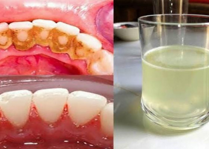 7 Bahan Alami yang Menghilangkan Karang Gigi dengan Mudah, Bikin Gigi Putih Merata Bebas Plak Gak Pakai Lama