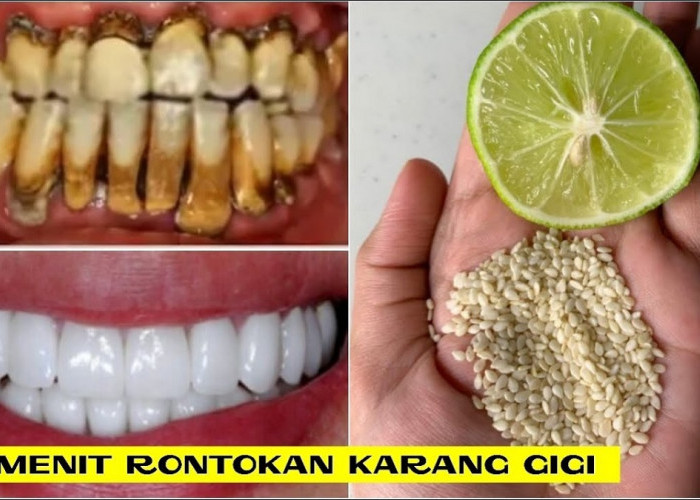 Kenali Penyebab Karang Gigi Mengeras dan Menebal, Simak 3 Cara Ampuh Bersihkan Karang Gigi Hingga Putih Alami