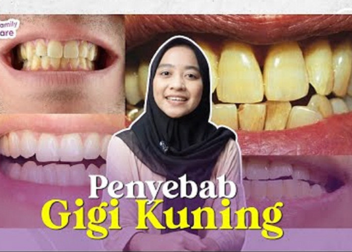 Inilah Penyebab Karang Gigi Kuning Bisa Muncul, Pahami Resiko dan Cara Mengatasinya