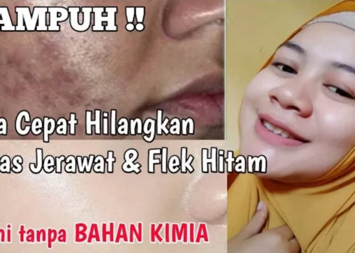 Begini Langkah Menghilangkan Flek Hitam Dalam Semalam! Ikuti 4 Langkah Pakai Minyak Zaitun untuk Muka Disini