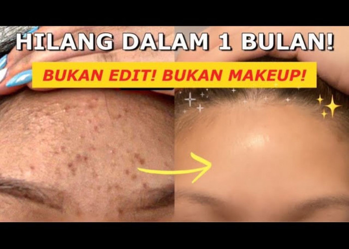 Inilah 3 Merk Serum yang Beneran Manjur untuk Menghilangkan Dark Spot di Wajah! Bikin Wajah jadi Cerah Glowing