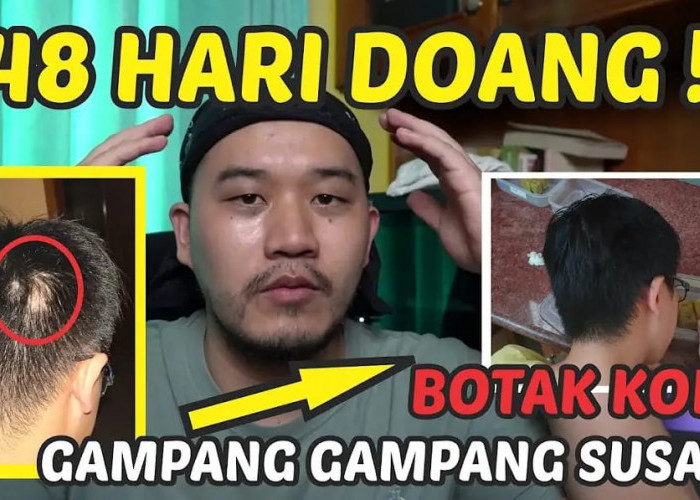 2 Cara Menumbuhkan Rambut Pitak dengan Rosemary Oil yang Benar