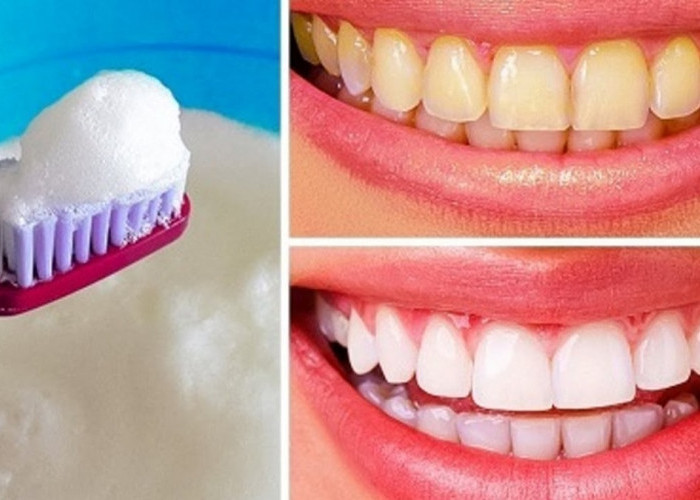 5 Cara Alami Merontokan Karang Gigi yang sudah Menebal dalam Semalam, Efektif Buat Membersihkan Gigi Putih