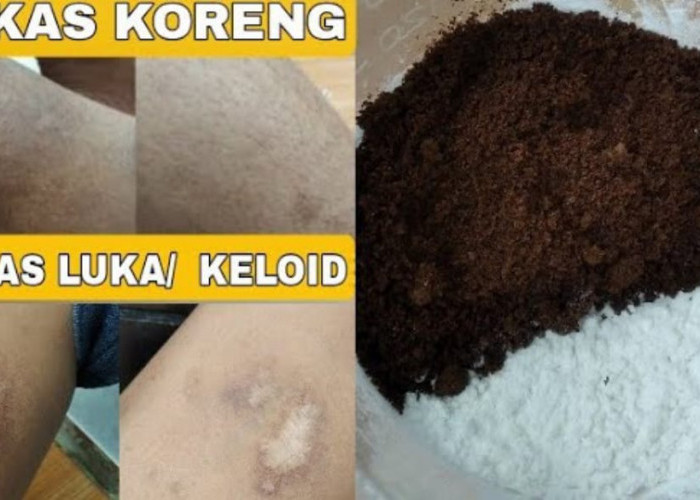 4 Cara Menghilangkan Bekas Luka Gatal di Kaki yang Menghitam dan Susah Hilang, Pakai Bahan Dapur Bebas Koreng