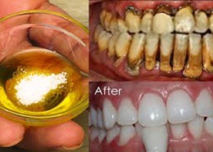 Cara Sederhana Menghilangkan Karang Gigi yang Sudah Mengeras dengan Minyak Zaitun, 6 Cara Gigi Putih Tidak Bau