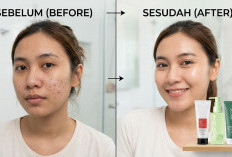 Ini Dia 4 Sabun Wajah yang Bagus untuk Kulit Berkomedo, Minimalkan Kemunculan Jerawat