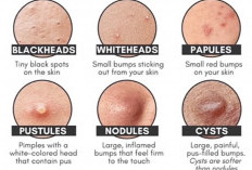 Sering Muncul Jerawat Saat Puasa?Ini 5 Cara Mencegah Breakout Selama Ramadan