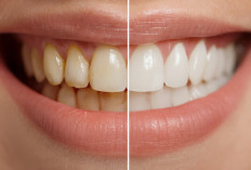 Inilah Cara Memutihkan Gigi yang Kuning dan Berkarang dengan Bahan Alami dalam 3 Hari