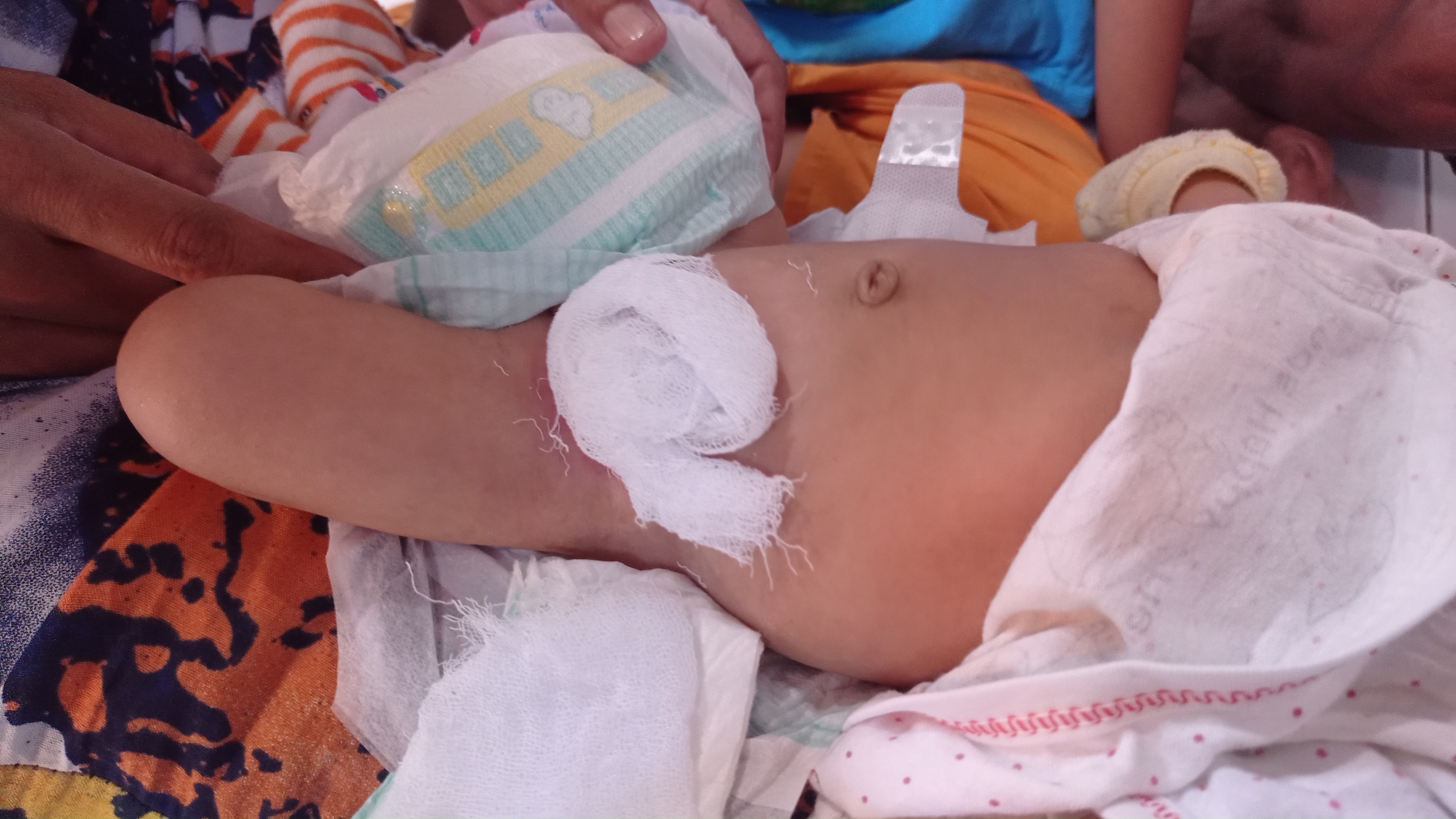 Muhammad Maulana Arshaq, Balita Tanpa Lubang Anus di Pekalongan Butuh Uluran Tangan dari Donatur