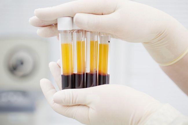Inilah 6 Fakta Terapi Plasma Darah untuk Obati Virus Corona